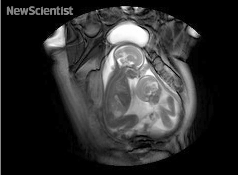 близнаци, бременост