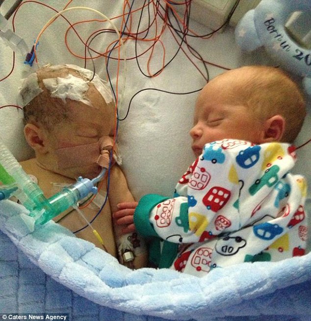 близнаците во болница