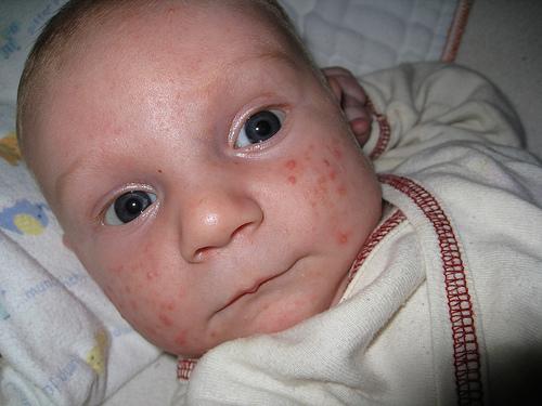 бебе со акни