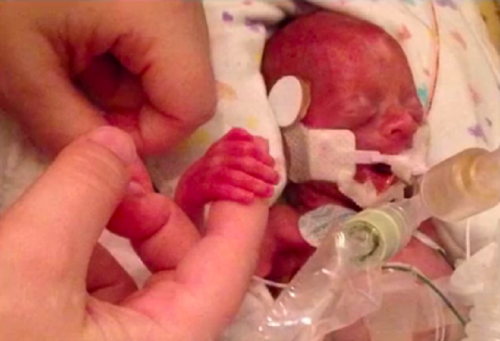 предвремено роден во 24 недела