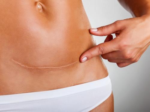 лузна по царски рез