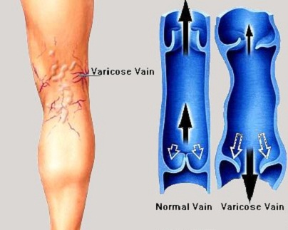 проширени - варикозни вени